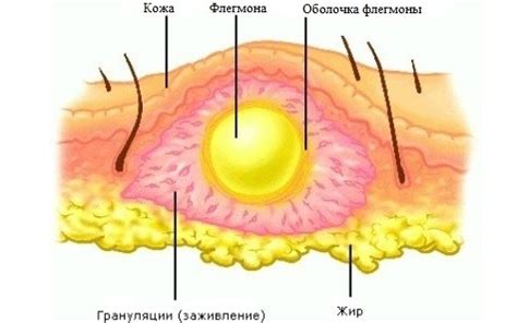 Реферат Гангрена Фурнье - shoppingholywrit