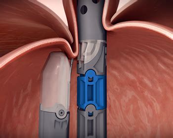 Endoscopic Treatment Of GERD - Mission Gastro Hospital