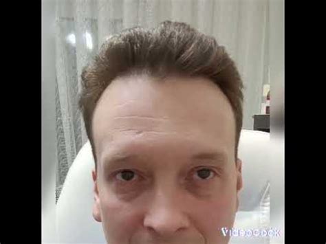 ботулотоксин до, и после )). - YouTube