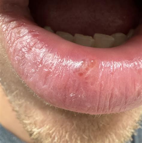 Is this a cold sore? No stinging just a bit tender : r/Coldsore