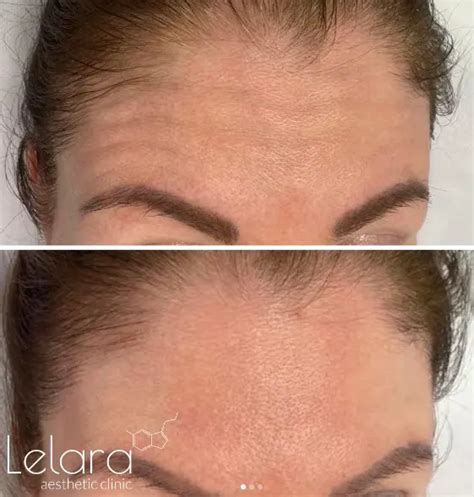 Full Face Botox in Dubai - Lelara Aesthetic Clinic