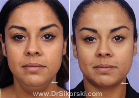 kybella     natural image oc