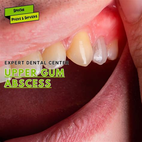 jaw abscess doctor explains dental abscess tooth abscess