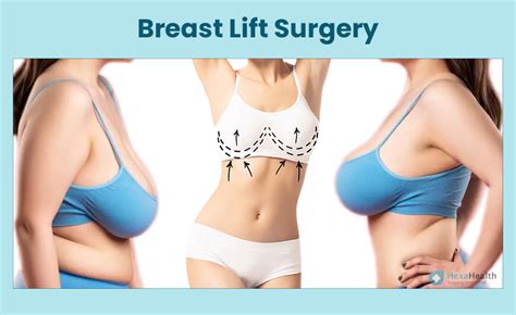 Breast Augmentation Lift | Breast Lift with Implants: Benefits vs