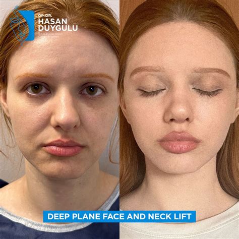 facelift     turkey dr hasan duygulu