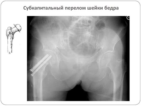 Повреждение бедра - презентация онлайн