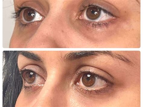 Plenhyage Before and After - Plenhyage XL | Dr Reham