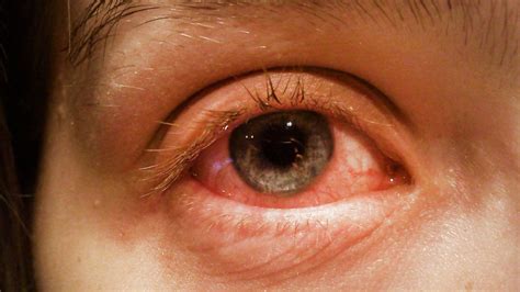50 Facts About Conjunctivitis - Facts.net