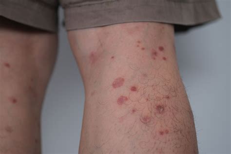 Psoriasis Behind the Knee: Symptoms, Causes and Treatment