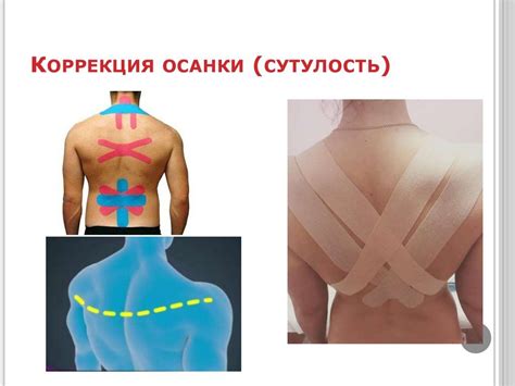 Коррекция осанки (сутулость) | Kinesiology taping, Massage classes ...