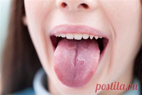 Болезни языка: причины воспалений, симптомы заболевания, изменение цв ...