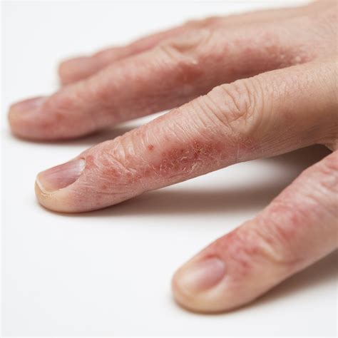 Dyshidrotic Eczema (Dyshidrosis): Symptoms, Causes, Treatments ...