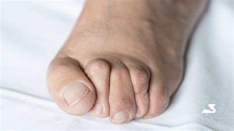 My doctor said I have ‘hammertoes’ and I suffer from corns on the tops ...