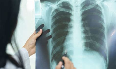 Cistična fibroza - Interna medicina - Moja Medicina