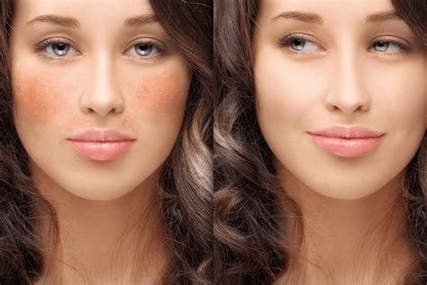 Prevent Hyperpigmentation in Summer - Life Blog