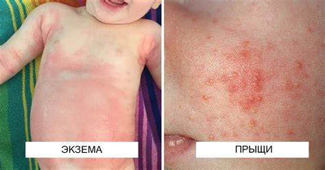У немовля прищі чи екзема? Просте керівництво, як їх відрізнити