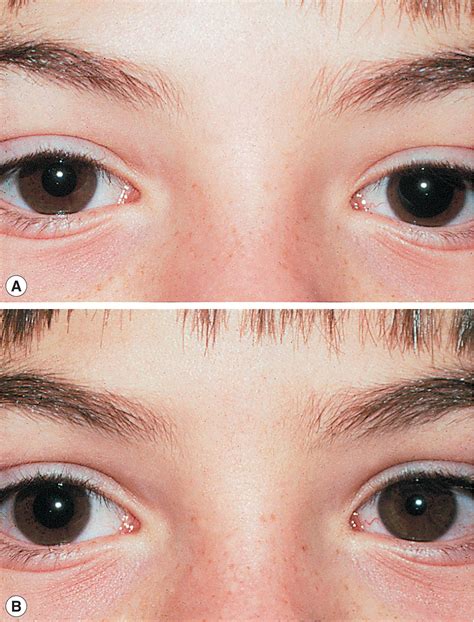 The pupil - Clinical Tree