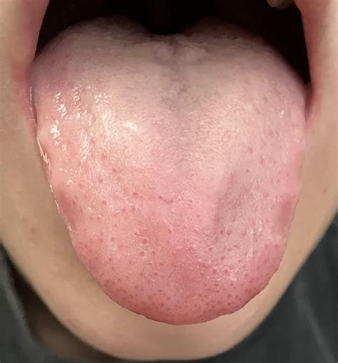 Is this tongue atrophy? : r/AskDoctorSmeeee