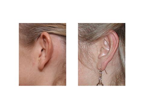 otoplasty-surgery-ear-pinning-dr-barry-eppley-indianapolis - Explore