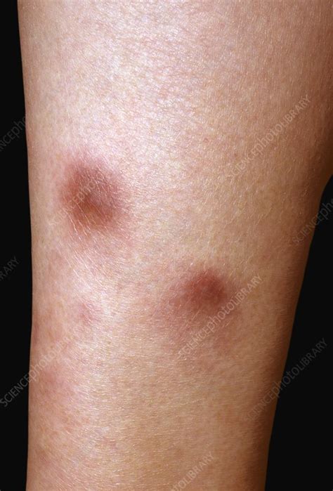 Erythema Nodosum Rash Stock Image C0024796 Science Ph - vrogue.co