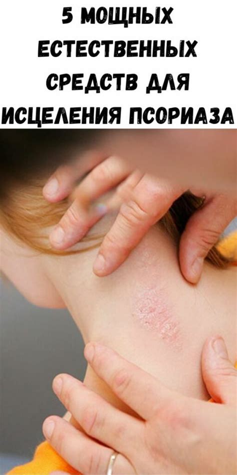 5 мощных естественных средств для исцеления псориаза - Стильные советы