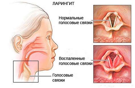 Беродуал: капли для ингаляций – инструкция детям и взрослым