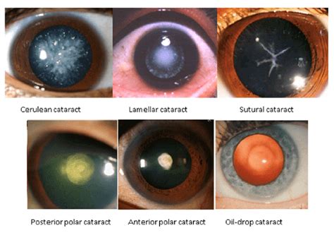 What is a Christmas tree or Snowflake cataracts? Learn about 13 ...