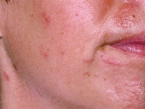 pollen allergy skin rash treatment