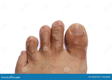 How To Get Rid Of Dry Skin Around Toes at John Mellon blog