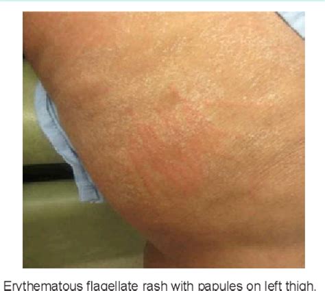 Figure 1 from Recurrent Rash Secondary to Shiitake Dermatitis ...