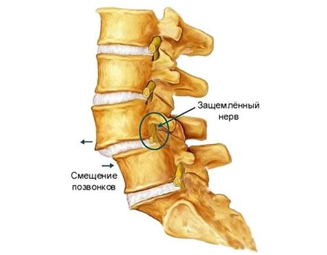 Спондилолистез: причины, симптомы и методы лечения