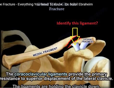 Management of Lateral third Clavicle Fractures — OrthopaedicPrinciples.com