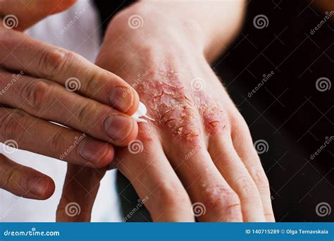 Eczema Op De Handen De Man Die De Zalf, Room in De Behandeling Van ...