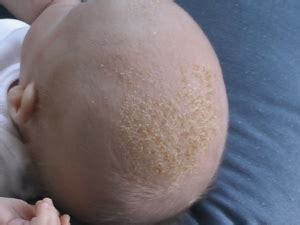 Neonatal seborrhoeic dermatitis - WikEM