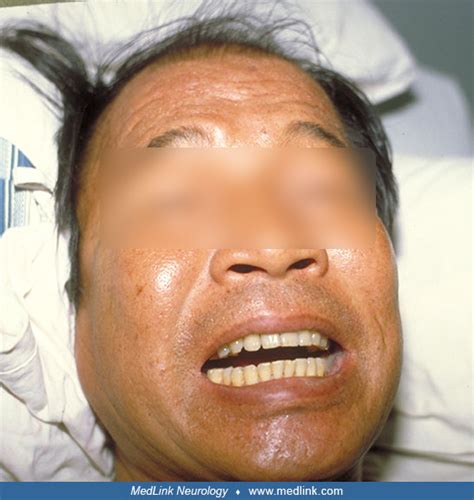 lockjaw tetanus   tetanus symptoms  diagnosis