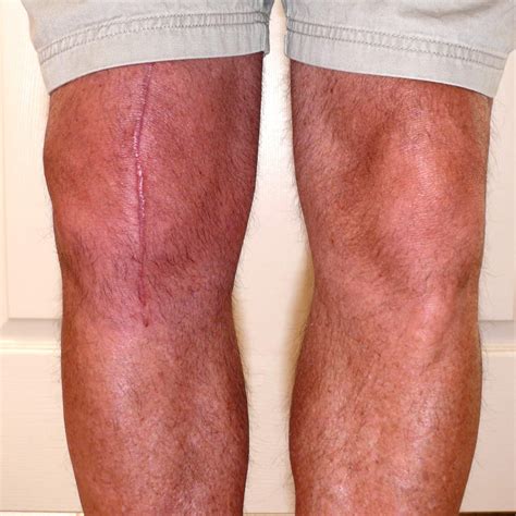 Partial Knee Replacement Scar