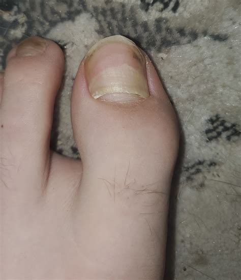 Missing bottom of toenail. : r/AskDocs