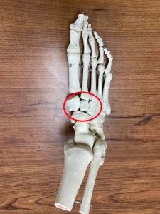 Cuneiform Fracture: Causes, Diagnosis & Treatment of Cuneiform Fractures