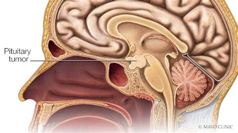 Pituitary gland tumors - Mayo Clinic News Network