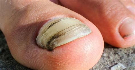 Toenail Fungus Causes Symptoms - Nail Ftempo