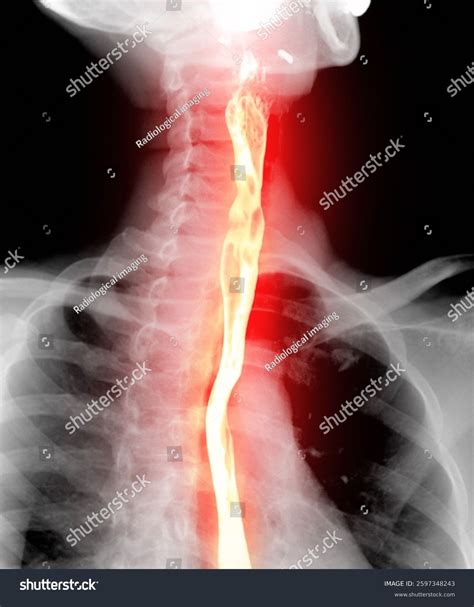Barium Swallow Study Test Diagnose Barretts Stock Illustration 2597348243 | Shutterstock