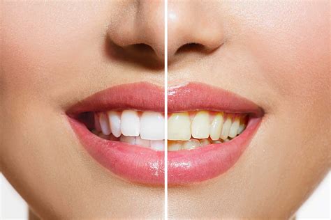 Yellow Teeth Are Actually Stronger Than Bright White Teeth | The Healthy