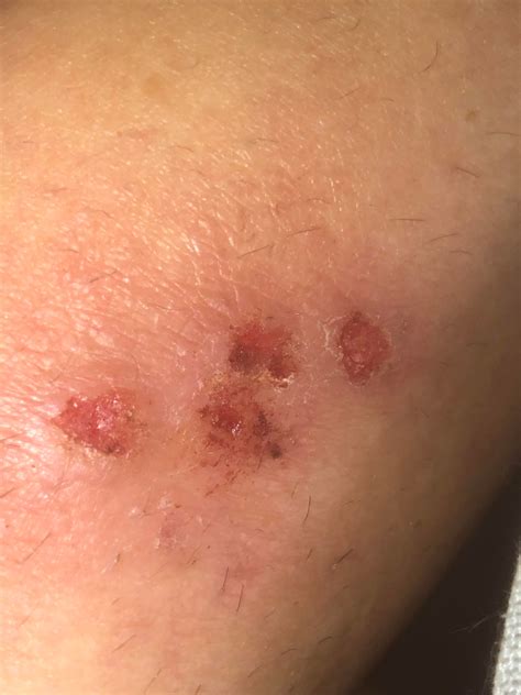 What is this??? Folliculitis? Ingrowns? Scabs? Infected? : r/Folliculitis