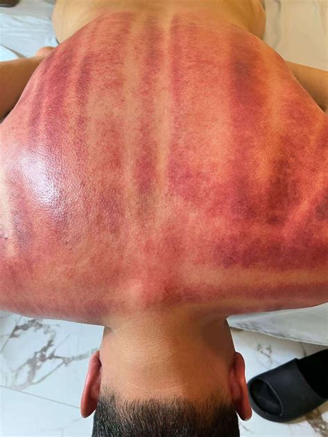 Sliding Cupping Therapy | Deep Tissue Release | Massage Comfy