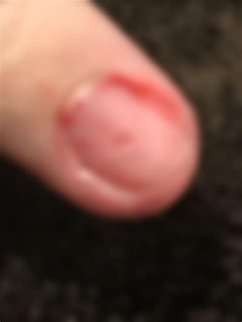 ok so I have a hole in my fingernail, it doesn't hurt unless something