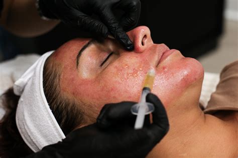Microneedling with PRP - Excell MedSpa