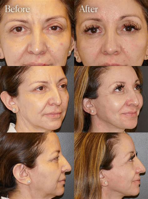 Brow Lift Photos | Denver, CO | Shah Aesthetic Surgery