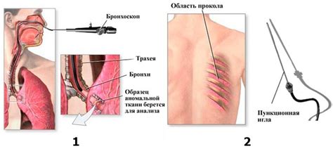 Что такое биопсия и как она проводится при раке легкого? А также роль ...