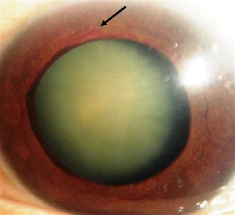 Preoperative biomicroscopic examination. Note the extensive iris ...