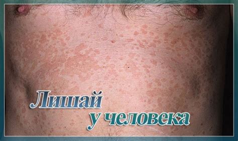 Лечения лишая у человека: основные методы устранения заболевания